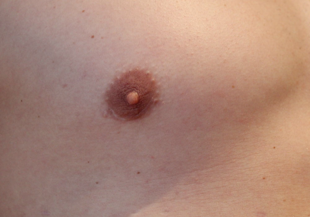 Scars after Gynecomastia surgery