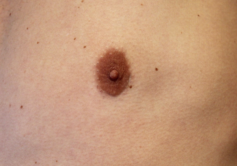 Scar after Gynecomastia surgery