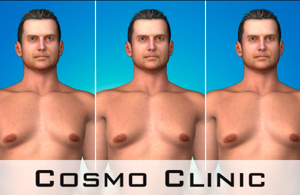 Gynecomastia surgery Men